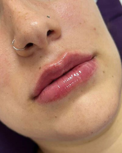 Preenchimento Labial