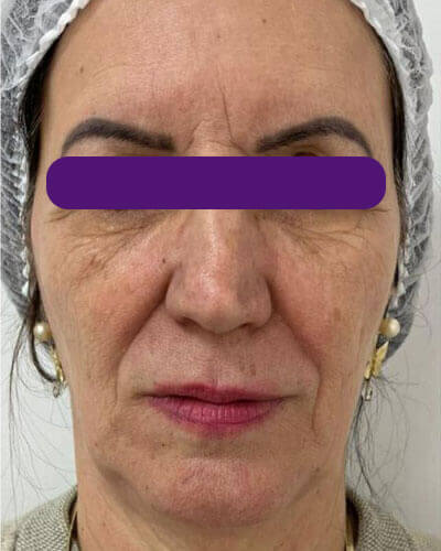 Rejuvenescimento Facial